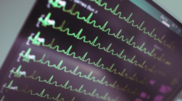 traitement battements irréguliers