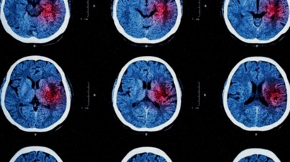 Traitement prévention AVC